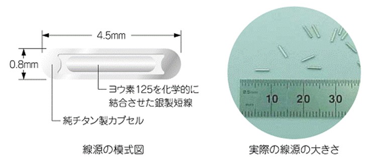 小線源療法とは