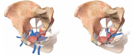 【経膣的骨盤底形成手術（TVM手術）】