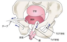 【TVT手術・TOT手術】