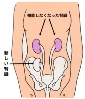 藤田医科大学での腎臓移植の特徴