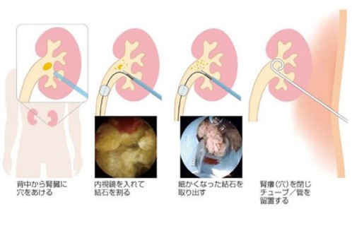 3. PNL（経皮的腎砕石術）