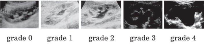 〈図1〉SFU（Society Fetal Urology） 分類による水腎症のgrade　小児先天性水腎症 診療手引き2016より