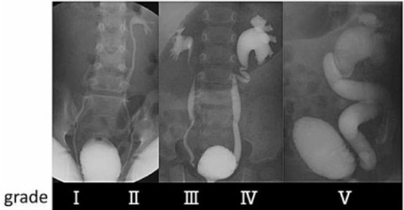 〈図２〉膀胱尿管逆流の国際分類　小児膀胱尿管逆流 診療手引き2016より